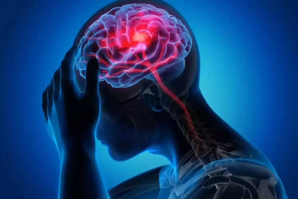 Brain-Stroke-1