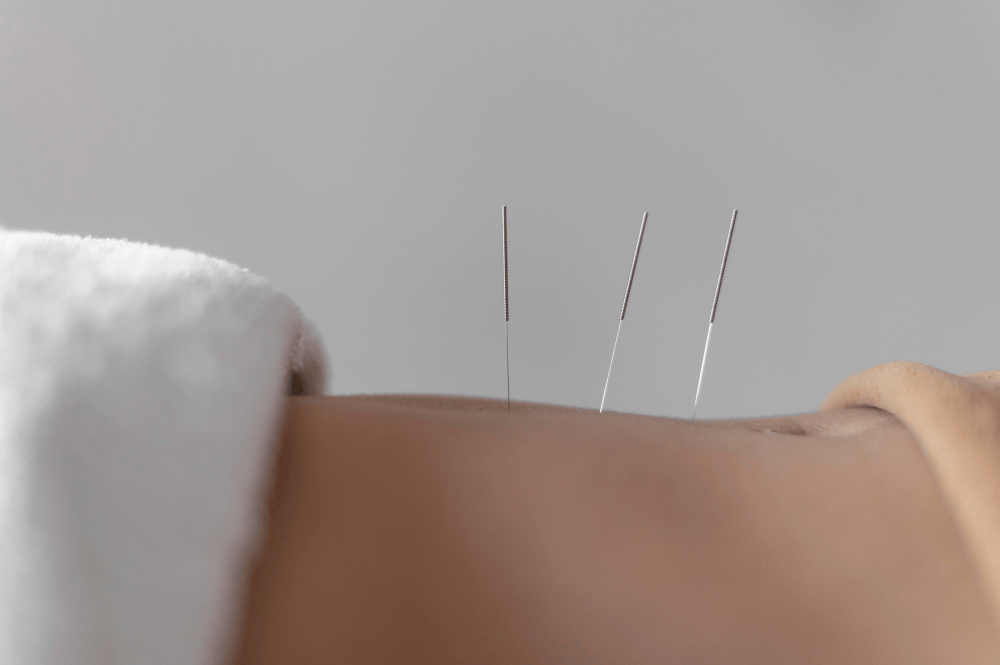 close-up-acupuncture-procedure